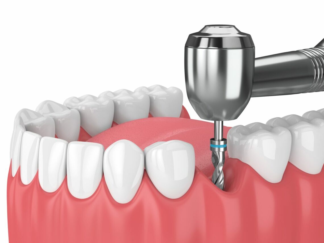 implant dentaire