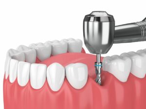 implant dentaire