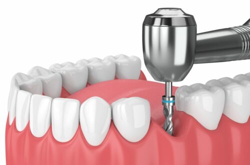 implant dentaire
