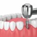 implant dentaire